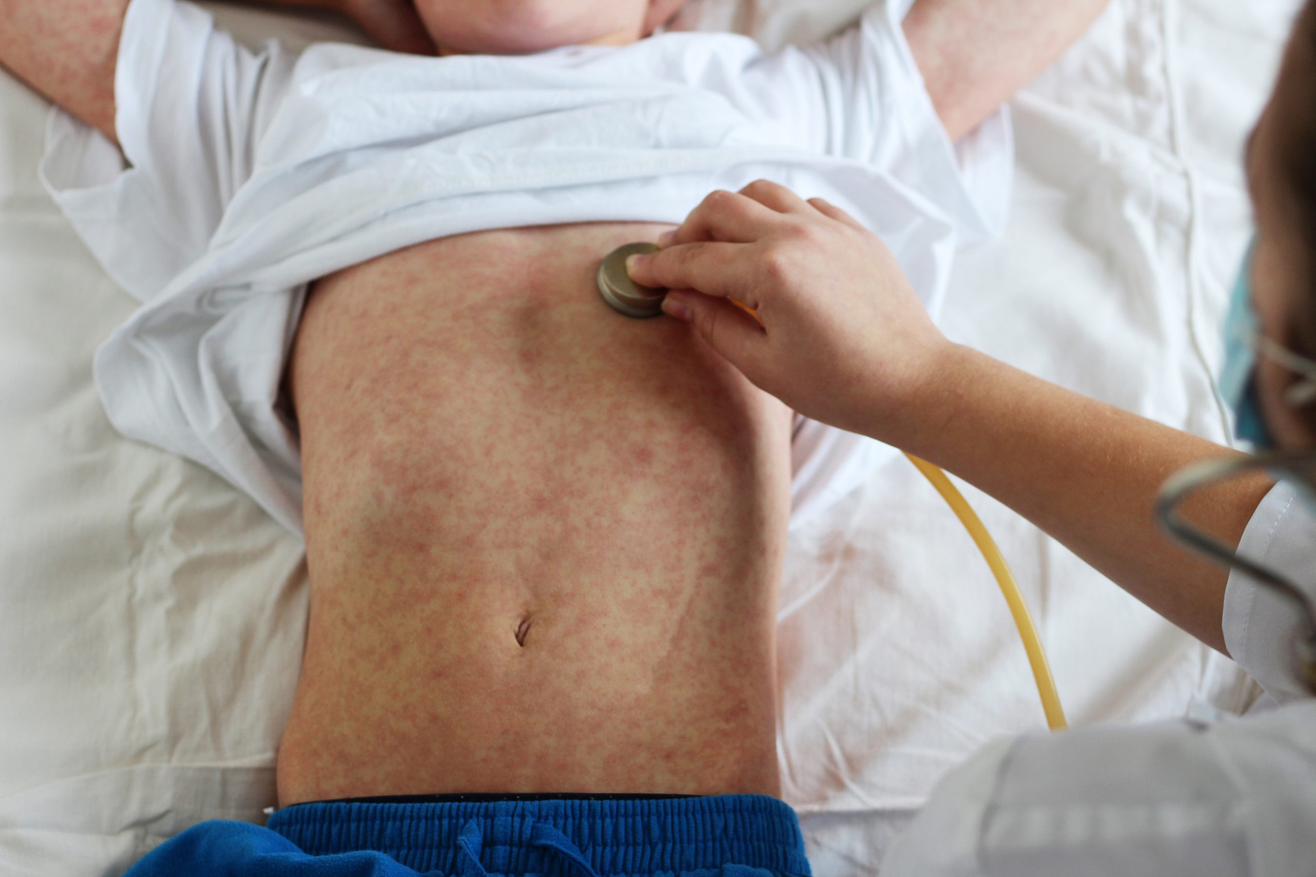 Diagnosing Measles