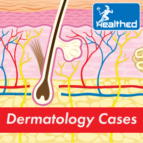 Dermatology Cases: Chronic Dandruff