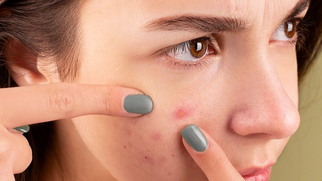 Practical tips for acne management - Healthed