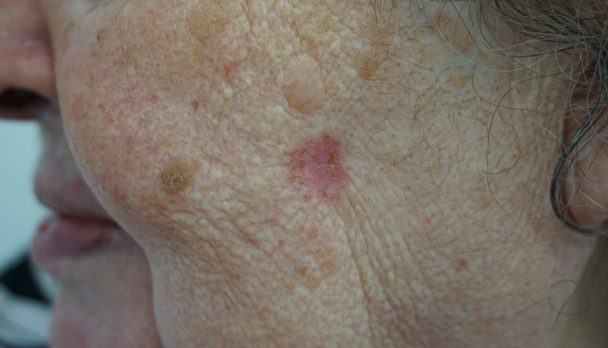 Article Feature Image - Scaly Plaque Cheek (no logo)