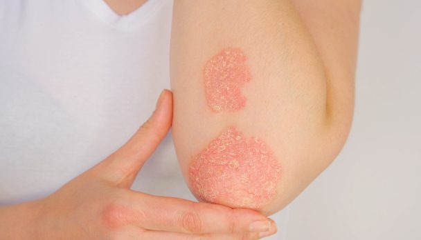 Psoriasis-Shutterstock-scaled