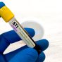 Biochemist,Or,Lab,Technologist,Holds,Blood,Sample,For,Sti,Or