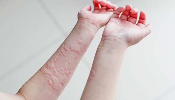 Understanding urticaria and angioedema