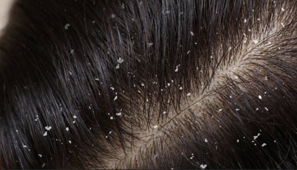 dandruff