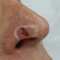 inset ulcer on nose