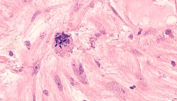 Microscopic,Image,Of,A,Leiomyosarcoma,,A,Type,Of,Soft,Tissue