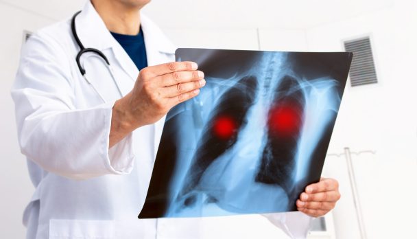 Lung,Cancer,Or,Pneumonia.,Doctor,Check,Up,X-ray,Image,Have