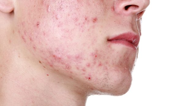 Adolescent wit acne